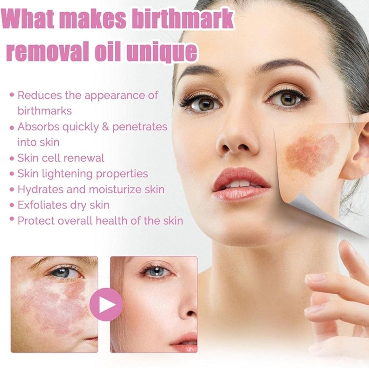 Birthmark Removal Oil 10ML (Pack of 2)